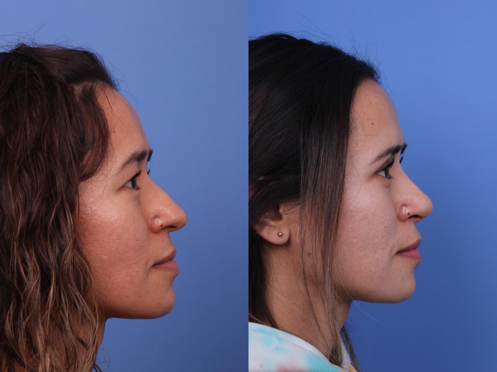 Before & After Ethnic Rhinoplasty Case 604 Right Side View in Scottsdale, AZ