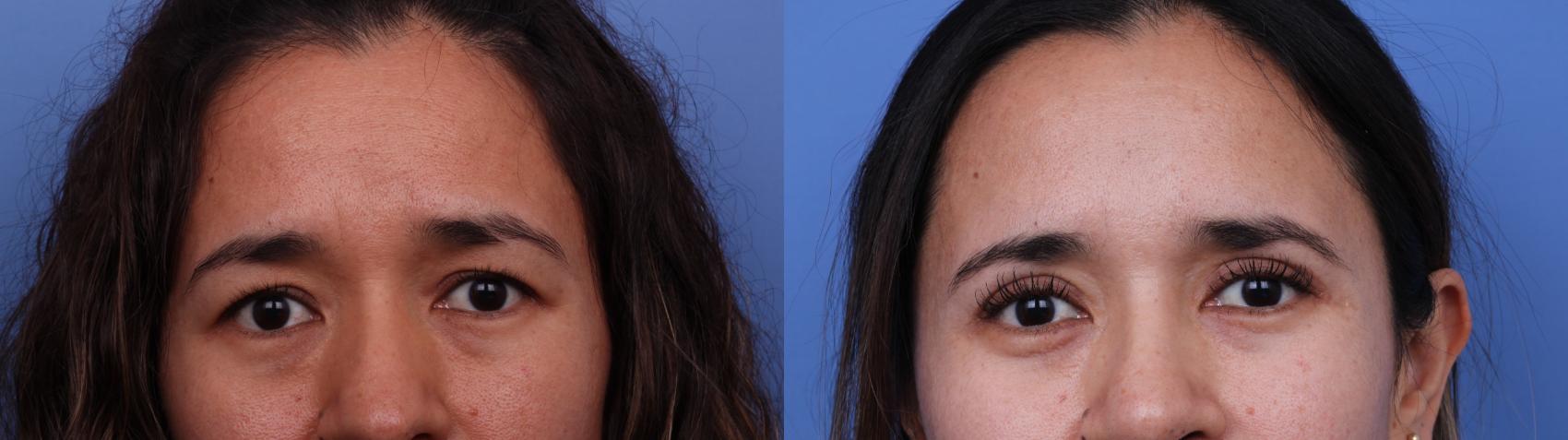 Before & After Ethnic Rhinoplasty Case 604 Zoom Bleph View in Scottsdale, AZ