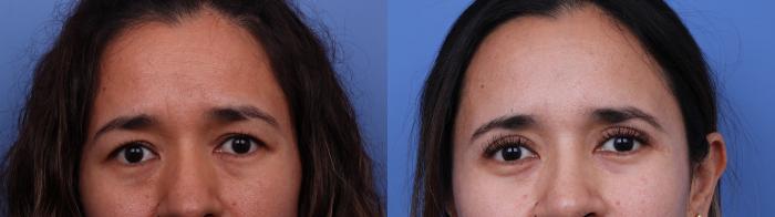 Blepharoplasty Before & After Photo | Scottsdale & Phoenix, AZ | Hobgood Facial Plastic Surgery: Todd Hobgood, MD