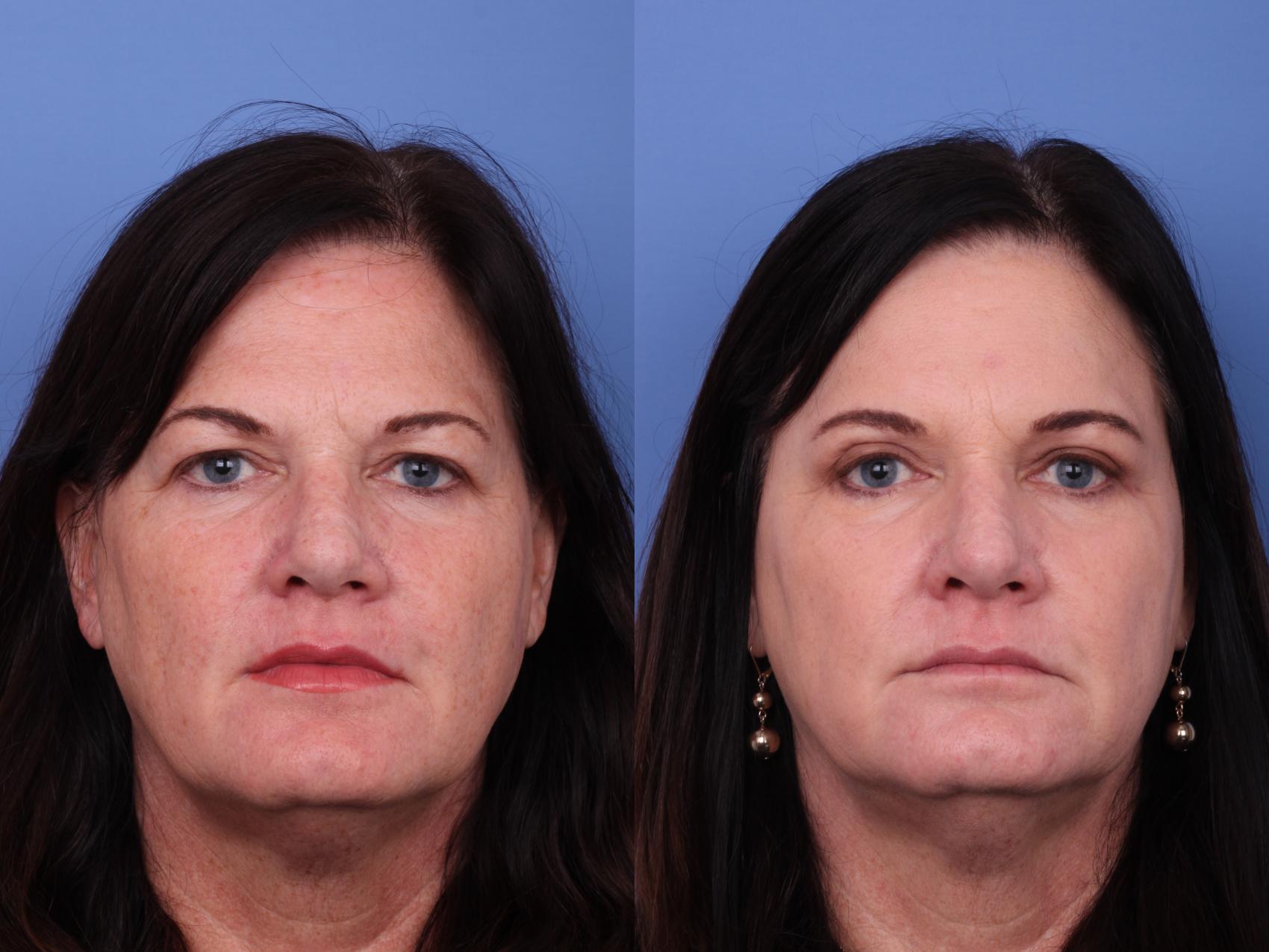 Before & After Blepharoplasty Case 616 Front View in Scottsdale, AZ