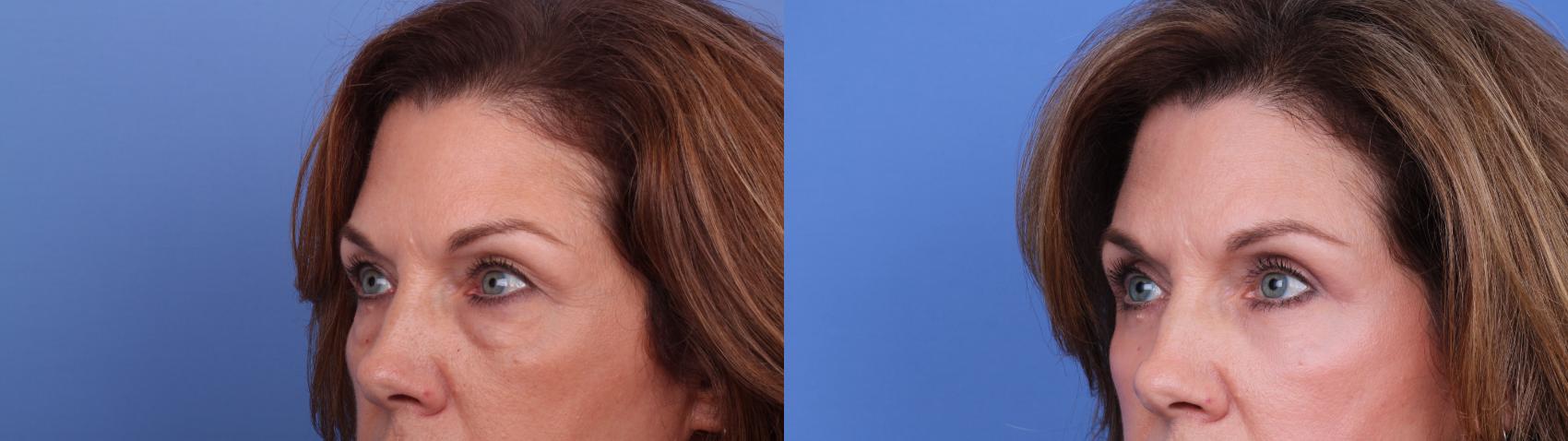 Before & After Blepharoplasty Case 629 Left Oblique View in Scottsdale, AZ