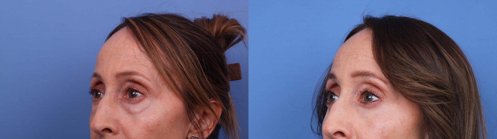 Before & After Blepharoplasty Case 630 Left Oblique View in Scottsdale, AZ