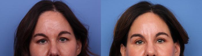 Blepharoplasty Before & After Photo | Scottsdale & Phoenix, AZ | Hobgood Facial Plastic Surgery: Todd Hobgood, MD