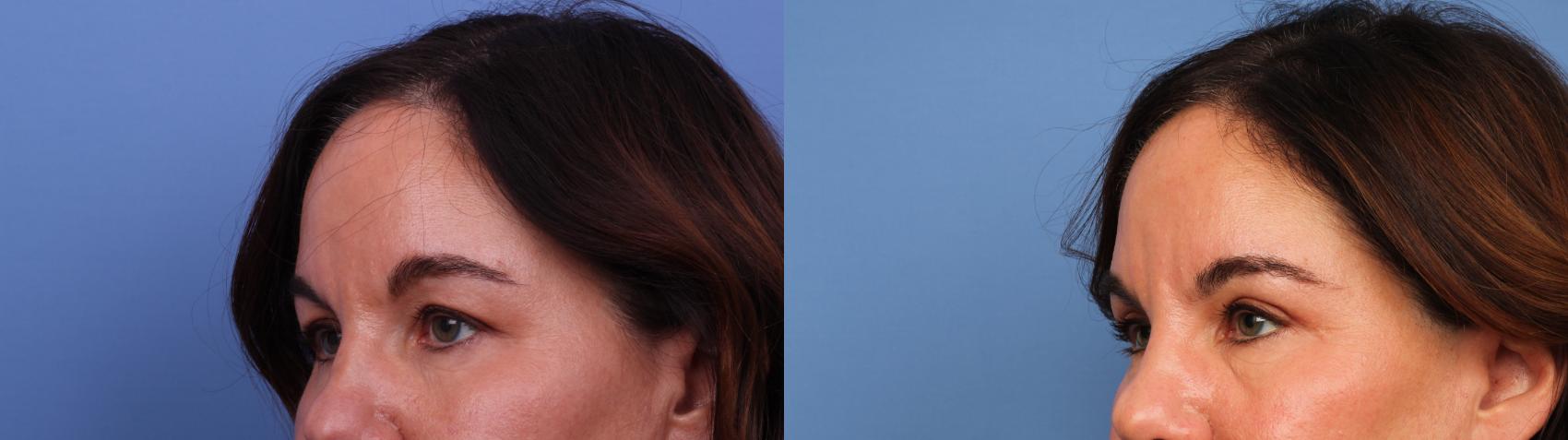 Before & After Blepharoplasty Case 643 Left Oblique View in Scottsdale, AZ