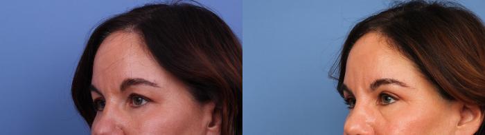 Blepharoplasty Before & After Photo | Scottsdale & Phoenix, AZ | Hobgood Facial Plastic Surgery: Todd Hobgood, MD