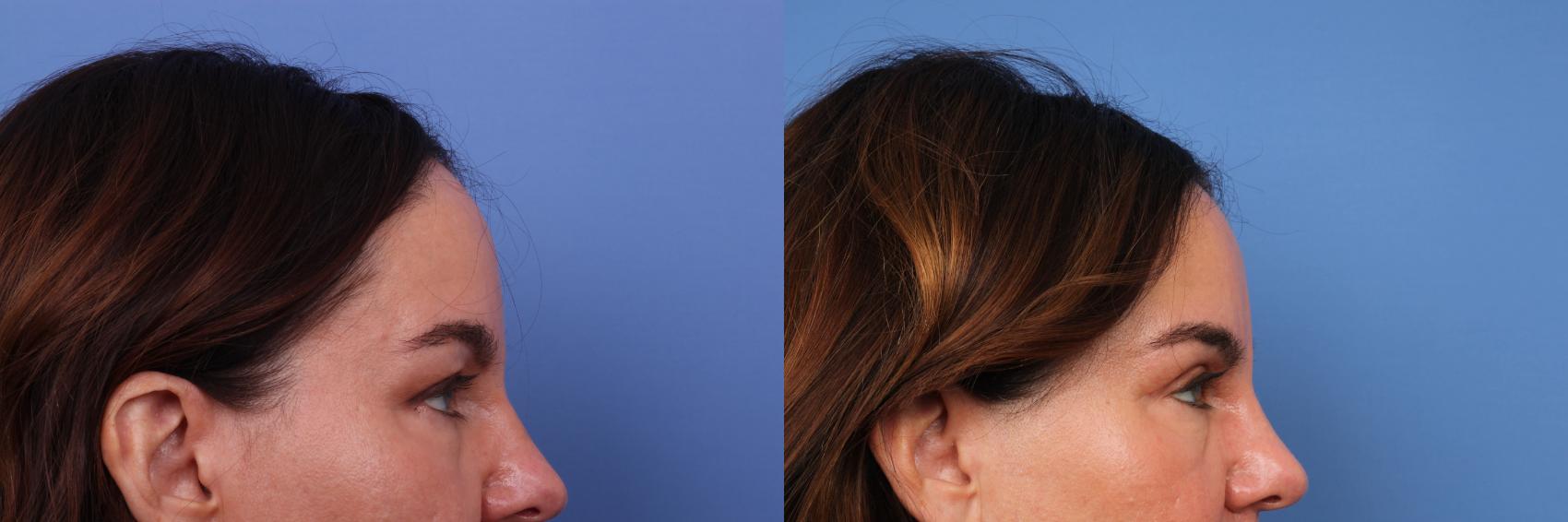 Before & After Blepharoplasty Case 643 Right Side View in Scottsdale, AZ