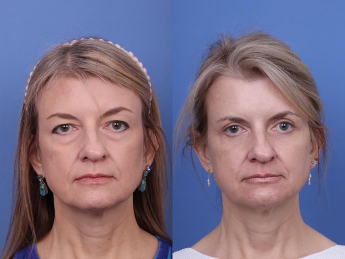 Blepharoplasty Before & After Photo | Scottsdale & Phoenix, AZ | Hobgood Facial Plastic Surgery: Todd Hobgood, MD