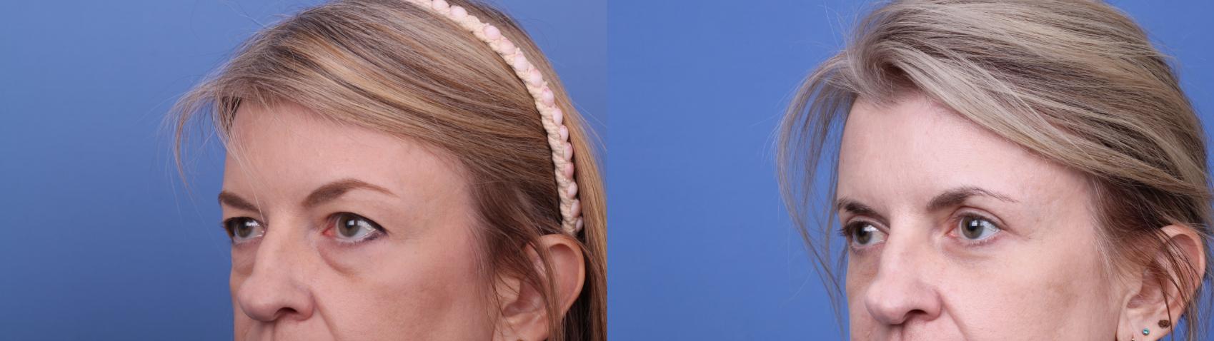 Before & After Blepharoplasty Case 644 Left Oblique View in Scottsdale, AZ