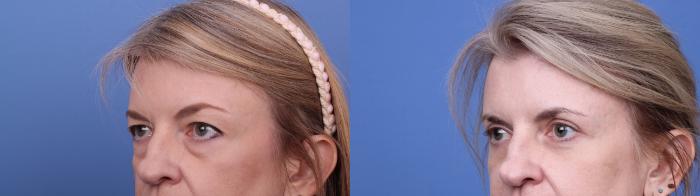 Blepharoplasty Before & After Photo | Scottsdale & Phoenix, AZ | Hobgood Facial Plastic Surgery: Todd Hobgood, MD