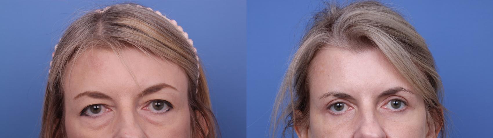 Before & After Blepharoplasty Case 644 Zoom Bleph View in Scottsdale, AZ