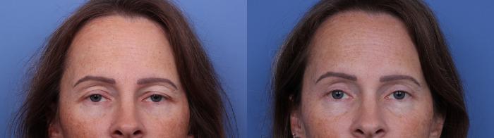 Blepharoplasty Before & After Photo | Scottsdale & Phoenix, AZ | Hobgood Facial Plastic Surgery: Todd Hobgood, MD