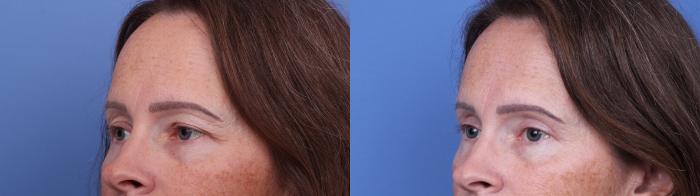 Blepharoplasty Before & After Photo | Scottsdale & Phoenix, AZ | Hobgood Facial Plastic Surgery: Todd Hobgood, MD