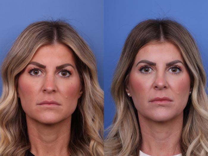 Blepharoplasty Before & After Photo | Scottsdale & Phoenix, AZ | Hobgood Facial Plastic Surgery: Todd Hobgood, MD