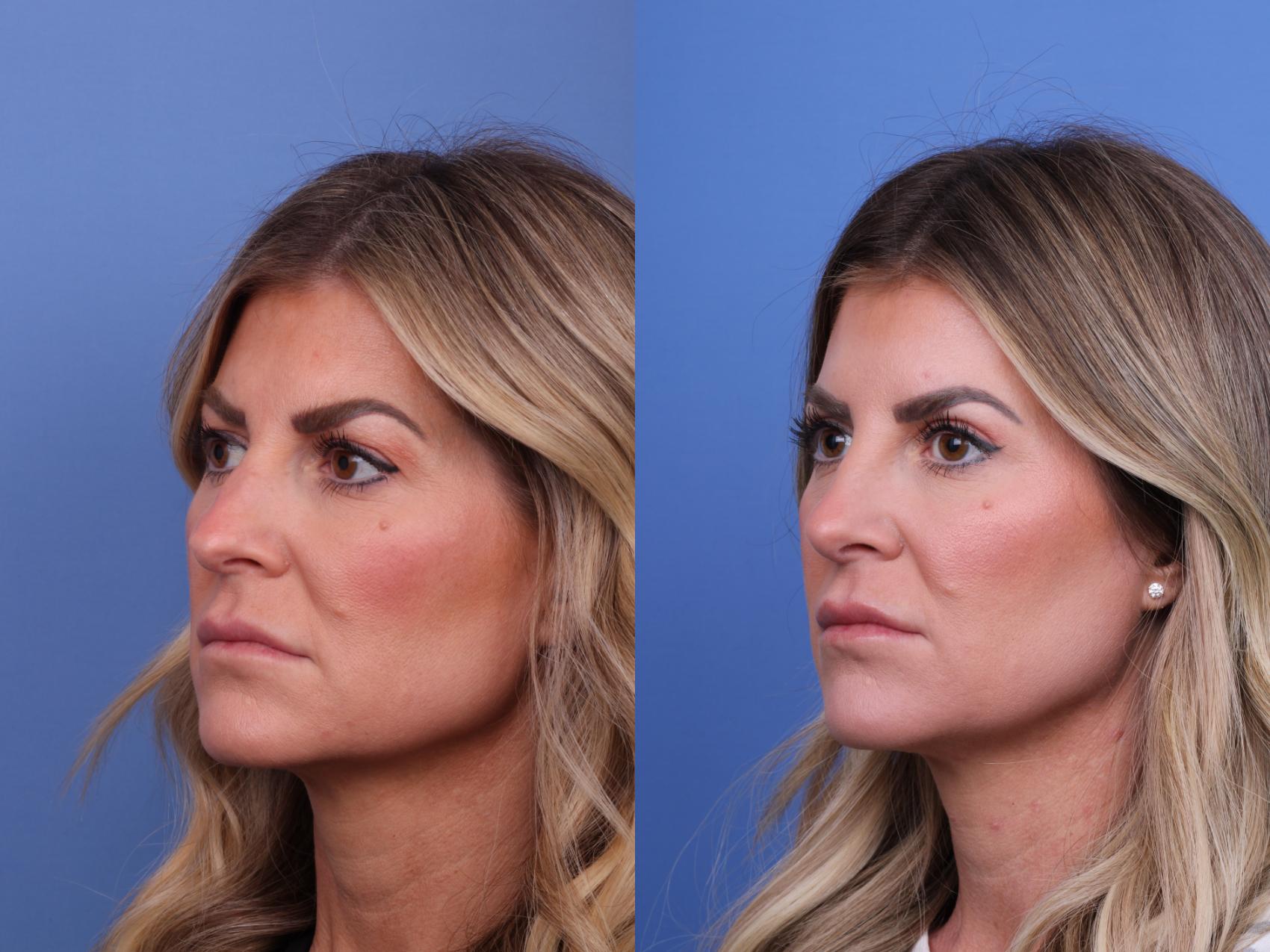 Before & After Rhinoplasty Case 648 Left Oblique View in Scottsdale, AZ