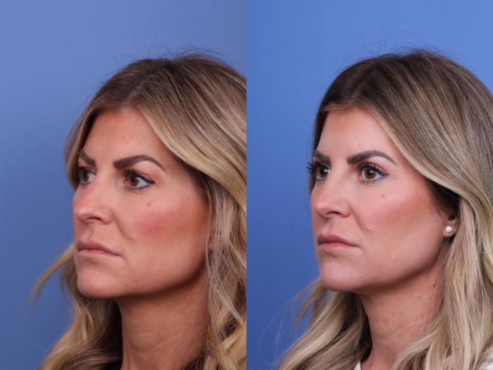 Blepharoplasty Before & After Photo | Scottsdale & Phoenix, AZ | Hobgood Facial Plastic Surgery: Todd Hobgood, MD