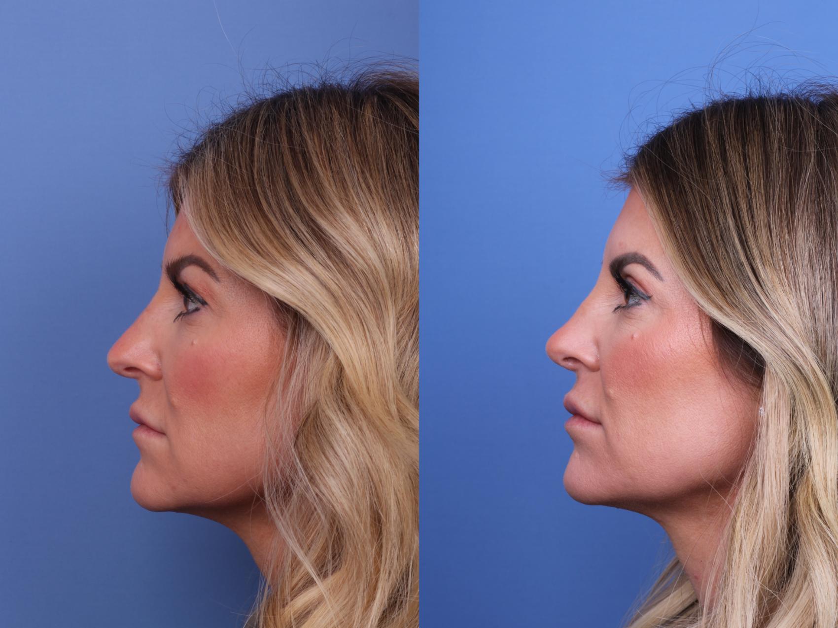 Before & After Rhinoplasty Case 648 Left Side View in Scottsdale, AZ