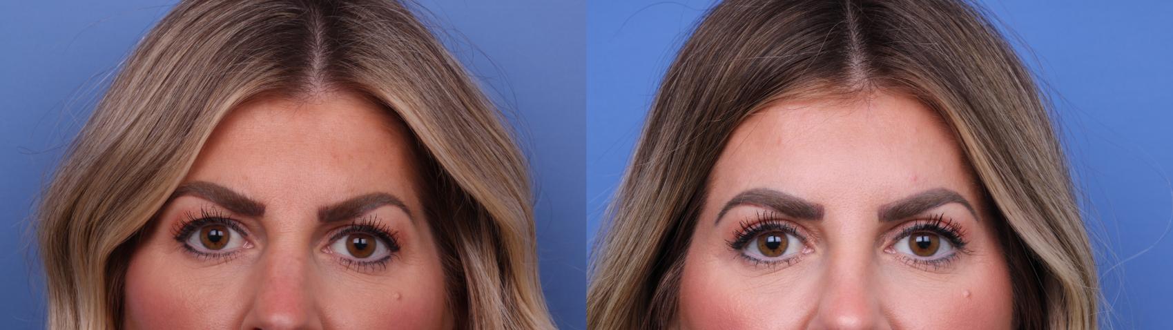 Before & After Rhinoplasty Case 648 Zoom Bleph View in Scottsdale, AZ