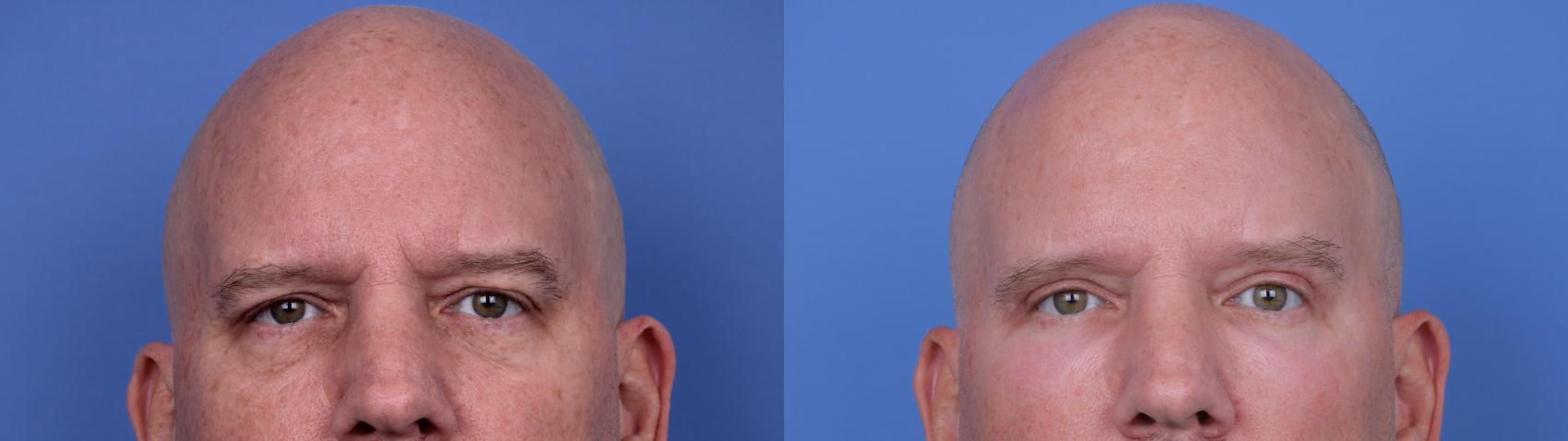 Before & After Blepharoplasty Case 652 Zoom Bleph View in Scottsdale, AZ