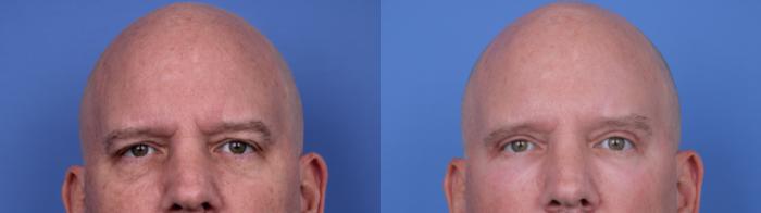 Blepharoplasty Before & After Photo | Scottsdale & Phoenix, AZ | Hobgood Facial Plastic Surgery: Todd Hobgood, MD