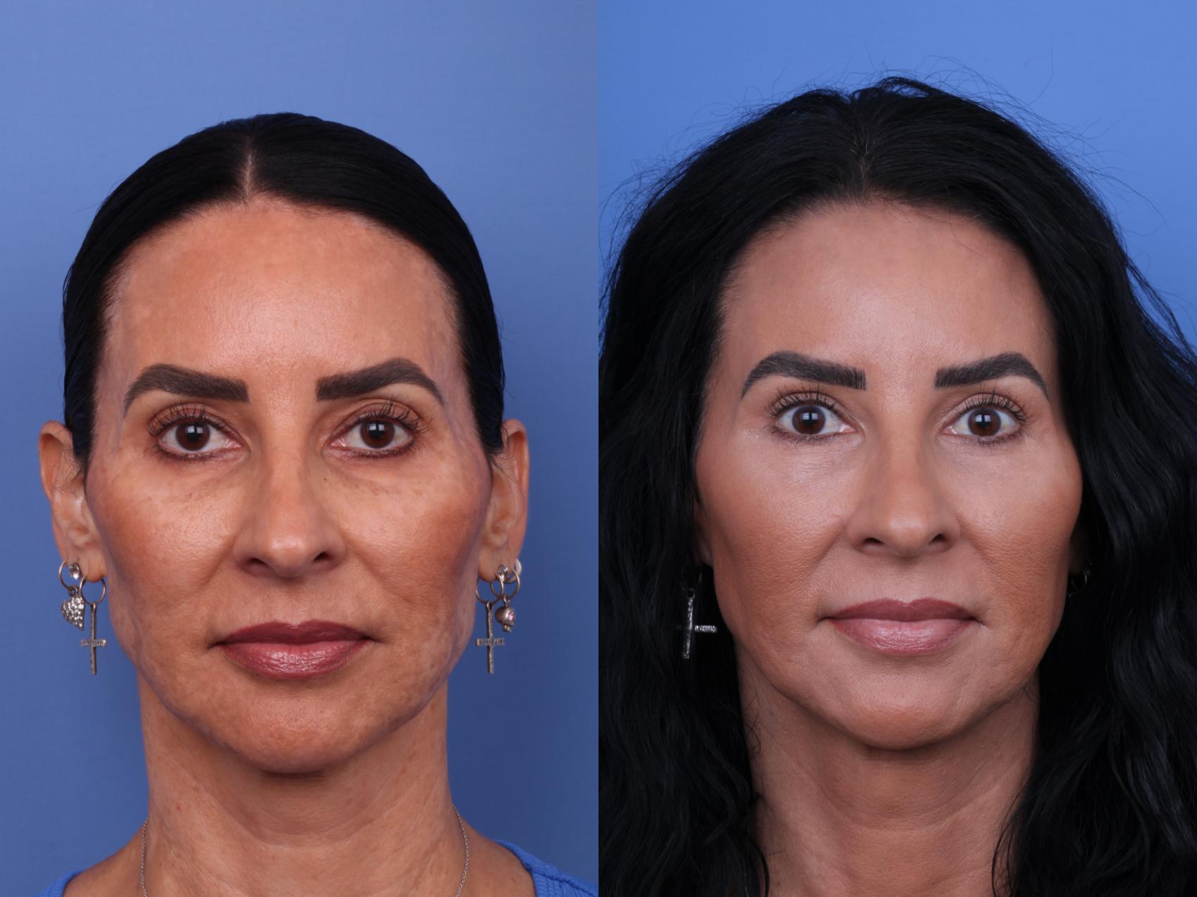 Before & After Blepharoplasty Case 659 Front View in Scottsdale, AZ