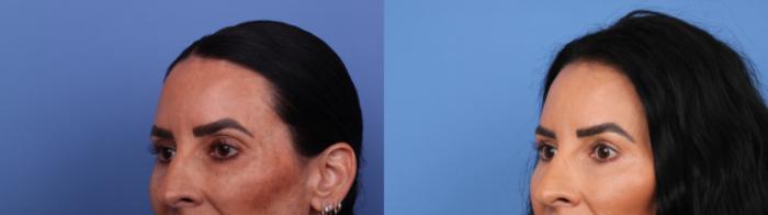 Before & After Blepharoplasty Case 659 Left Oblique View in Scottsdale, AZ