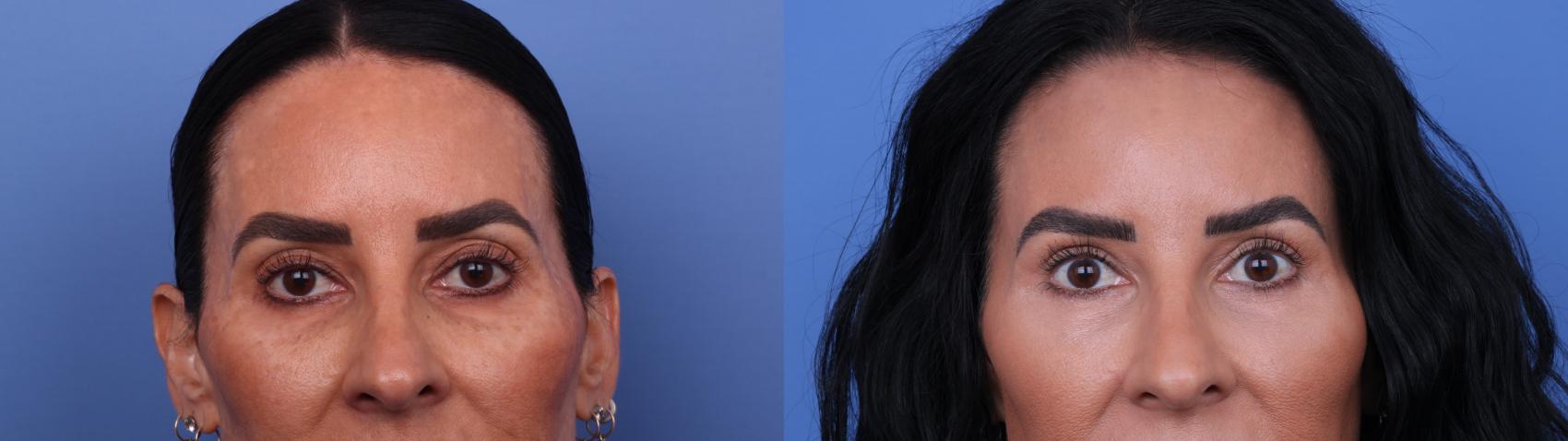 Before & After Blepharoplasty Case 659 Zoom Blepharoplasty View in Scottsdale, AZ
