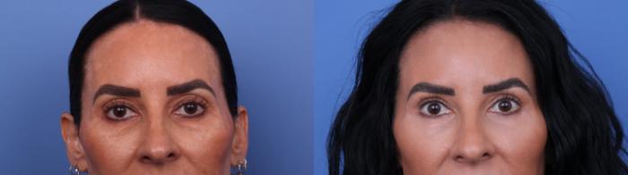 Before & After Blepharoplasty Case 659 Zoom Blepharoplasty View in Scottsdale, AZ