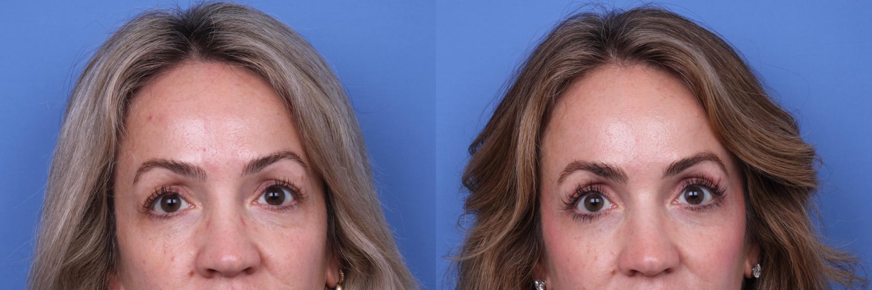 Before & After Blepharoplasty Case 661 Front View in Scottsdale, AZ