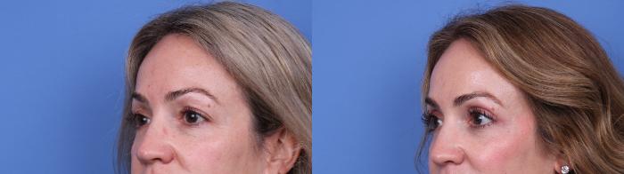 Before & After Blepharoplasty Case 661 Left Oblique View in Scottsdale, AZ