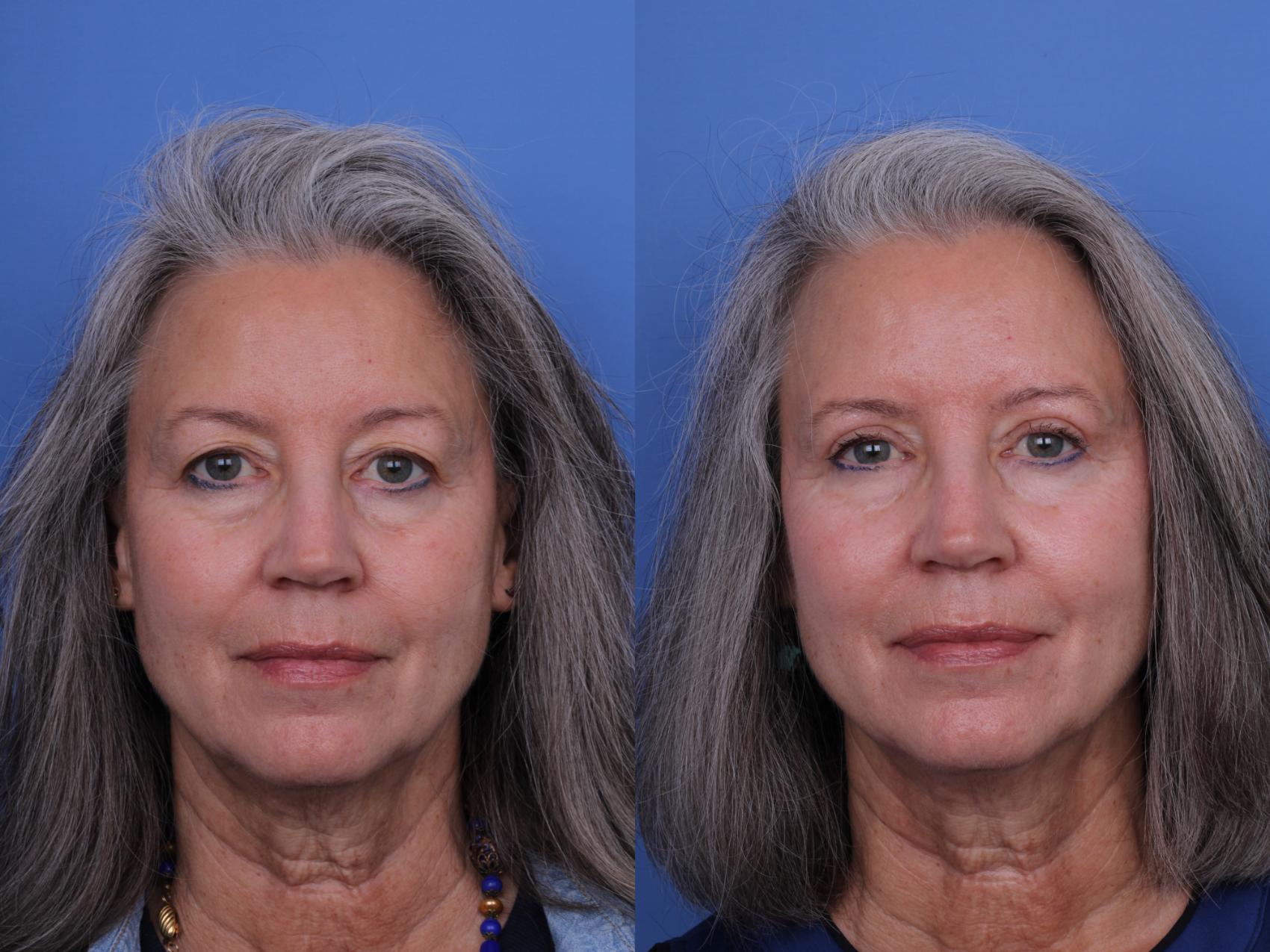 Before & After Blepharoplasty Case 665 Front View in Scottsdale, AZ