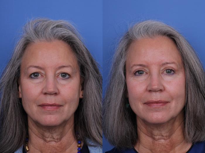 Before & After Blepharoplasty Case 665 Front View in Scottsdale, AZ