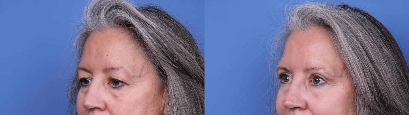 Before & After Blepharoplasty Case 665 Left Oblique View in Scottsdale, AZ