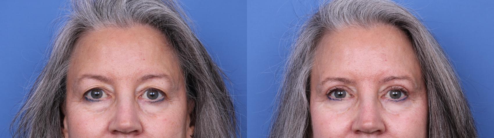 Before & After Blepharoplasty Case 665 Zoom Blepharoplasty View in Scottsdale, AZ