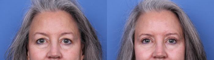 Before & After Blepharoplasty Case 665 Zoom Blepharoplasty View in Scottsdale, AZ