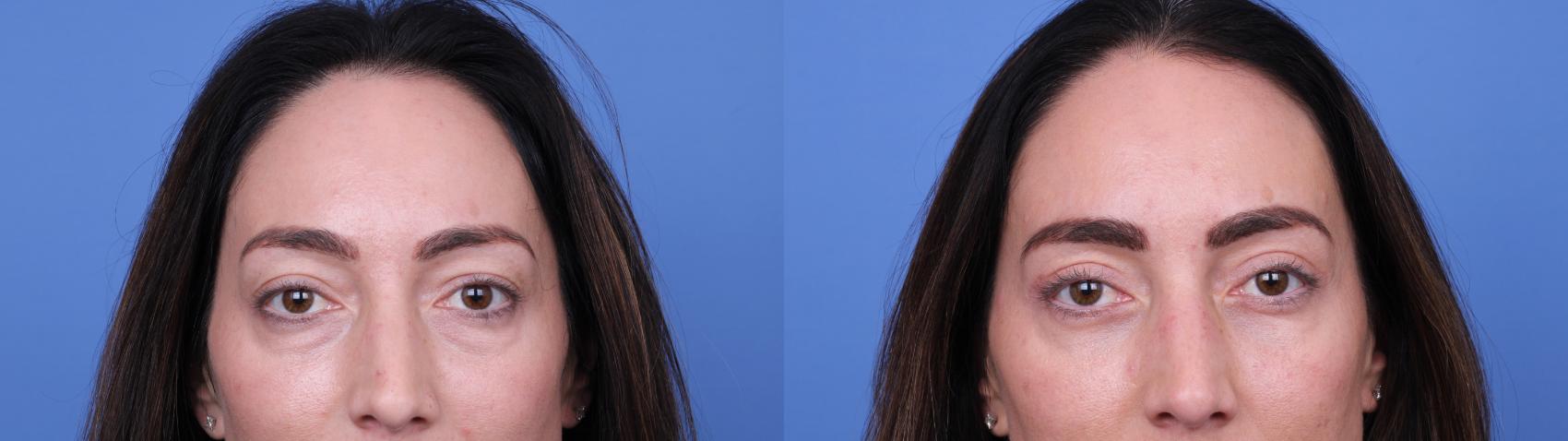 Before & After Blepharoplasty Case 676 Front View in Scottsdale, AZ