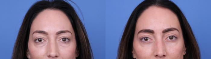 Before & After Blepharoplasty Case 676 Front View in Scottsdale, AZ