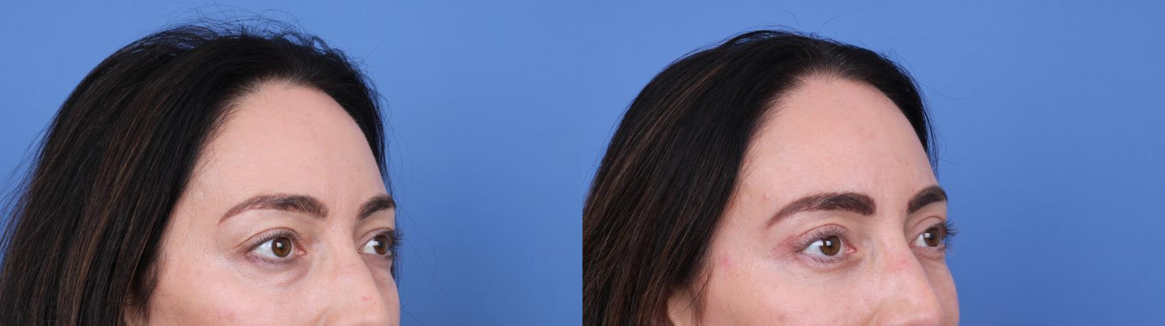 Before & After Blepharoplasty Case 676 Right Oblique View in Scottsdale, AZ