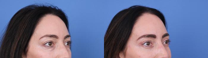 Before & After Blepharoplasty Case 676 Right Oblique View in Scottsdale, AZ