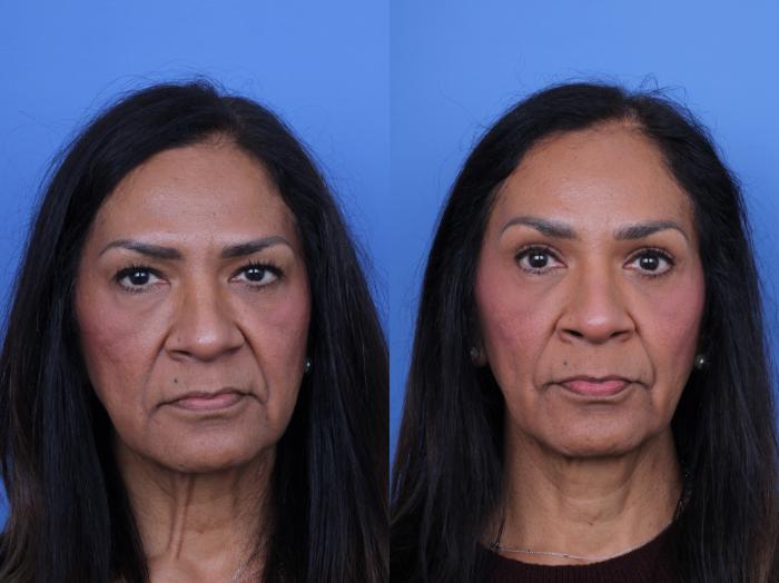 Before & After Brow Lift Case 685 Front View in Scottsdale, AZ