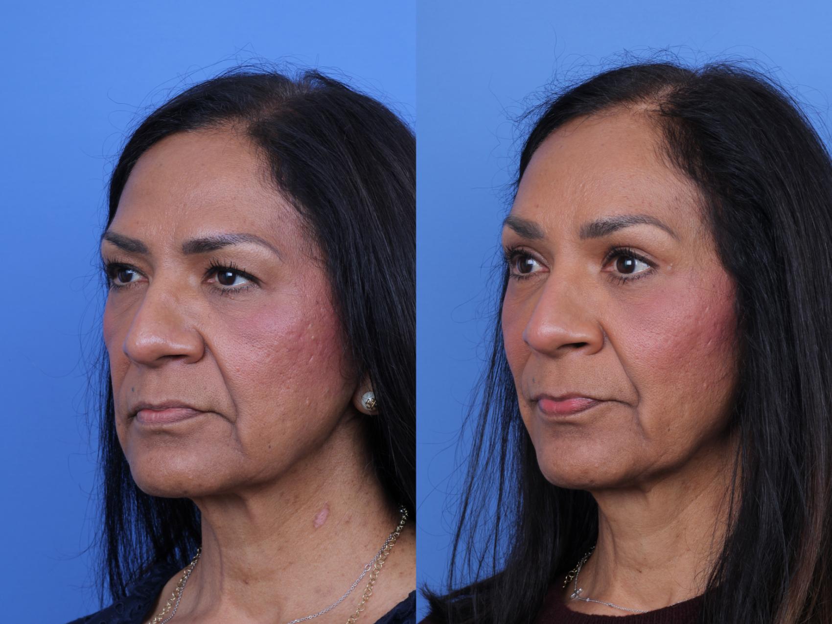 Before & After Brow Lift Case 685 Left Oblique View in Scottsdale, AZ