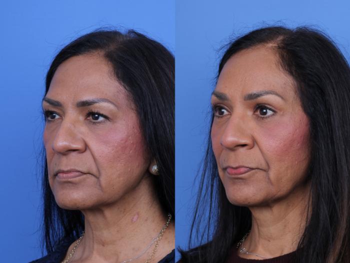 Before & After Brow Lift Case 685 Left Oblique View in Scottsdale, AZ
