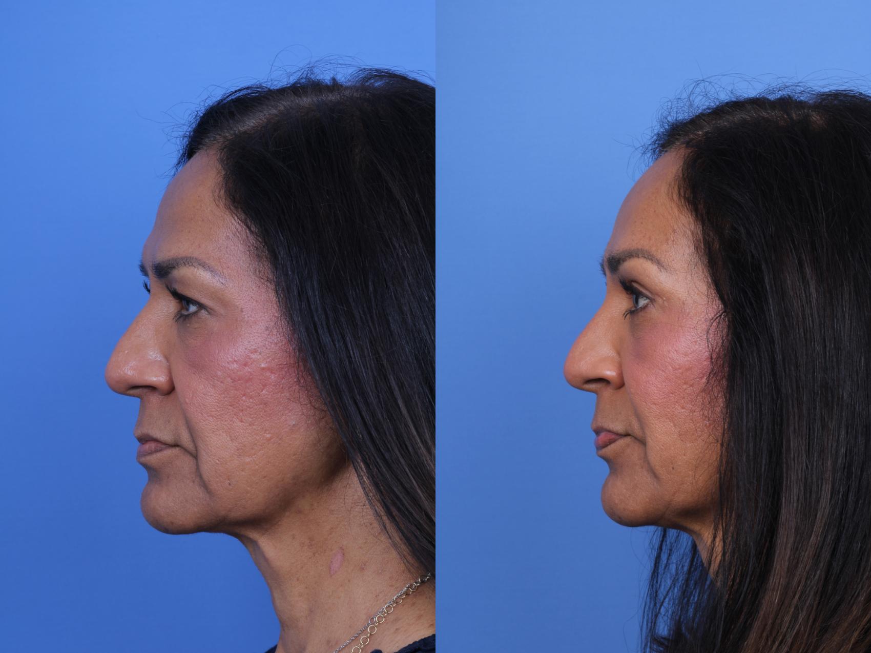 Before & After Brow Lift Case 685 Left Side View in Scottsdale, AZ
