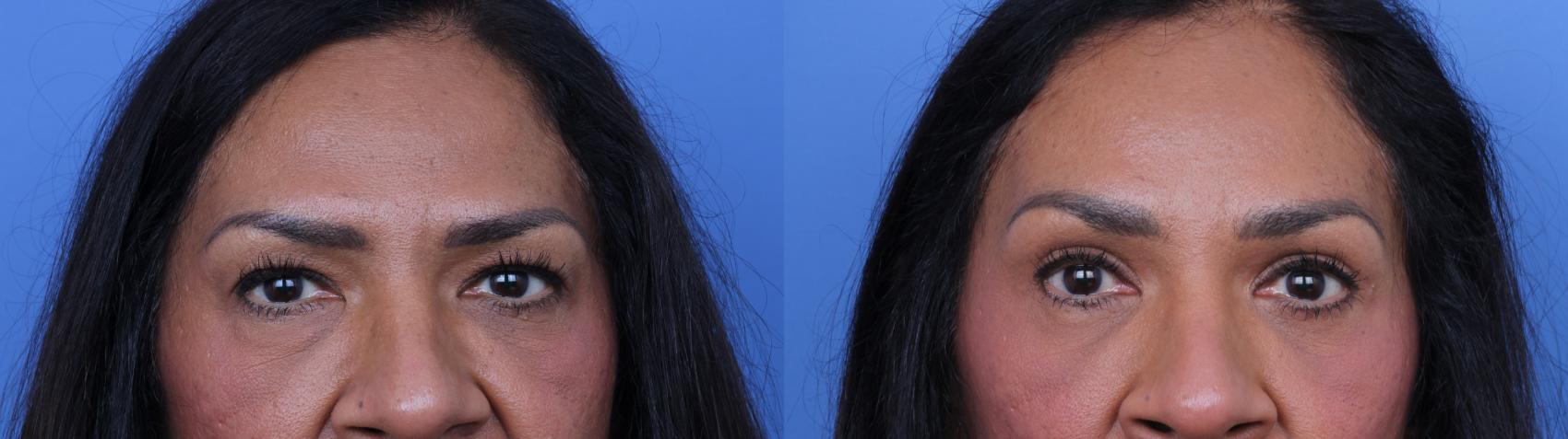 Before & After Brow Lift Case 685 Zoom Blepharoplasty View in Scottsdale, AZ