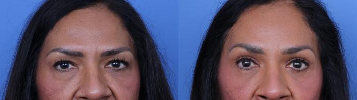 Before & After Brow Lift Case 685 Zoom Blepharoplasty View in Scottsdale, AZ