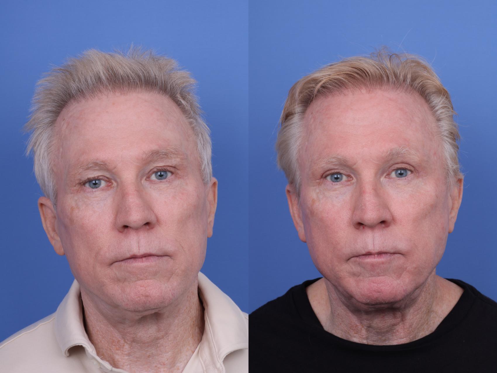 Before & After Blepharoplasty Case 686 Front View in Scottsdale, AZ