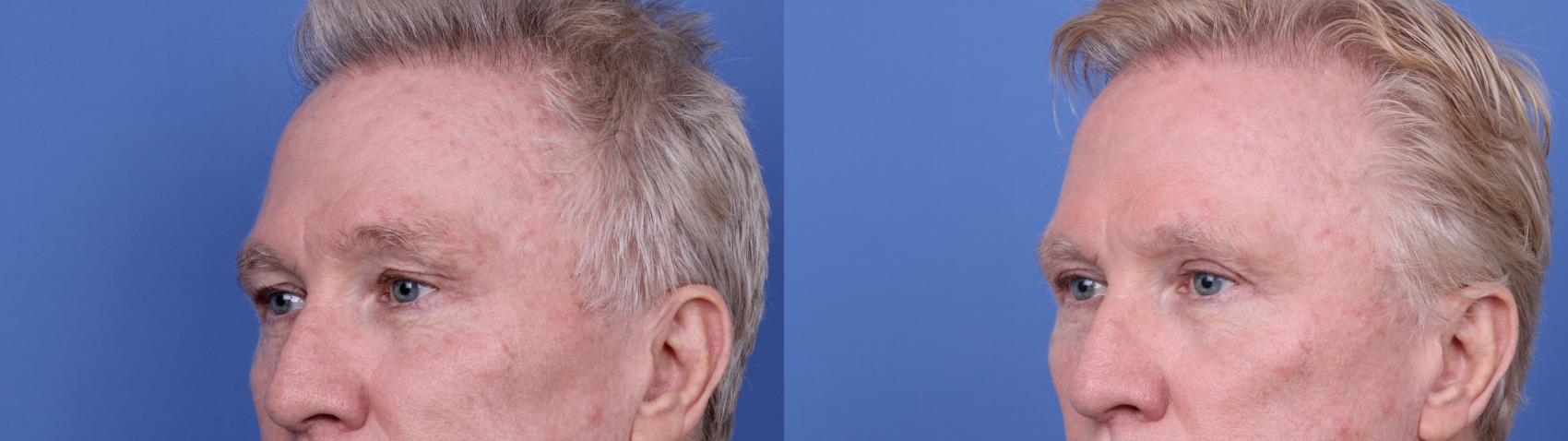 Before & After Blepharoplasty Case 686 Left Oblique View in Scottsdale, AZ