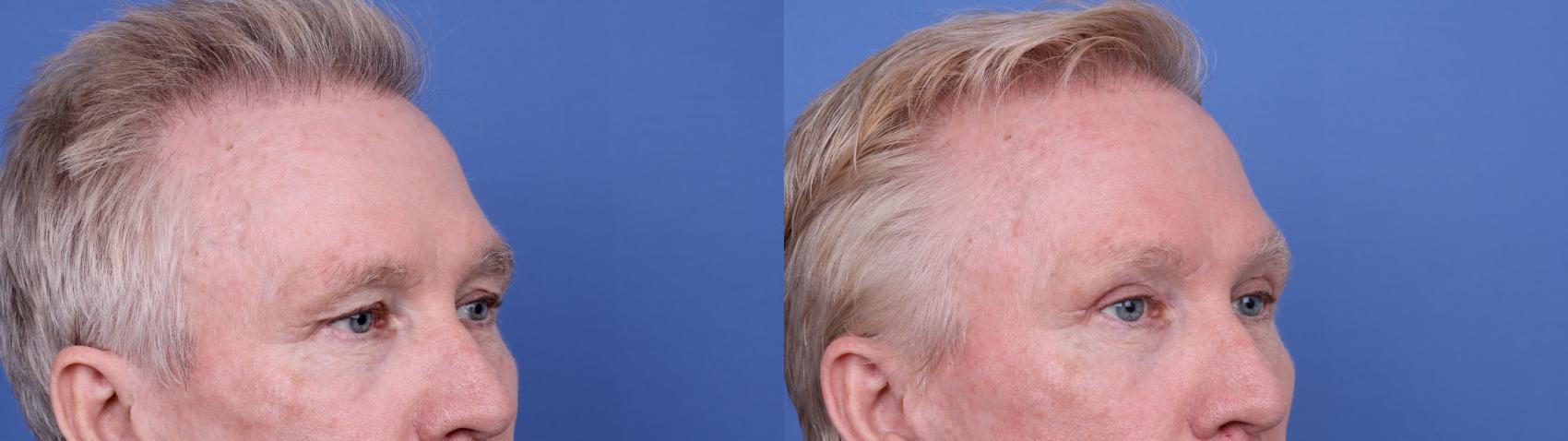 Before & After Blepharoplasty Case 686 Right Oblique View in Scottsdale, AZ
