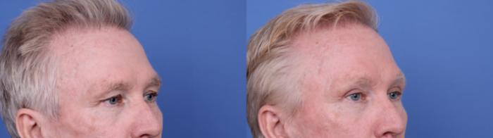 Before & After Blepharoplasty Case 686 Right Oblique View in Scottsdale, AZ