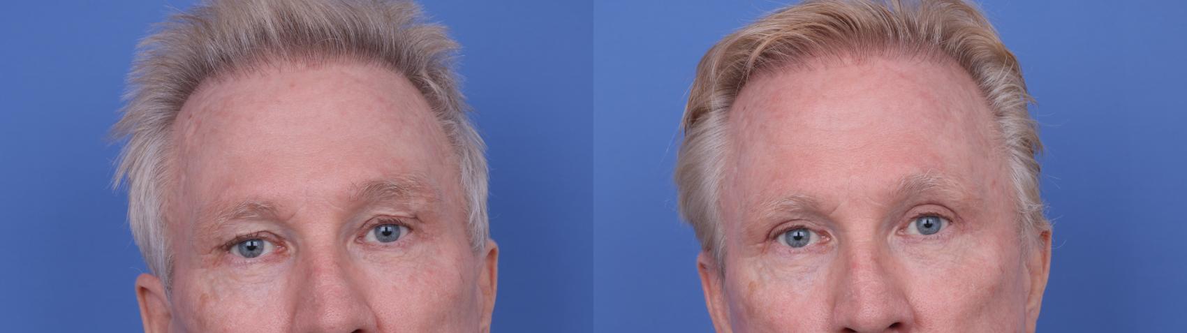 Before & After Blepharoplasty Case 686 Zoom Blepharoplasty View in Scottsdale, AZ