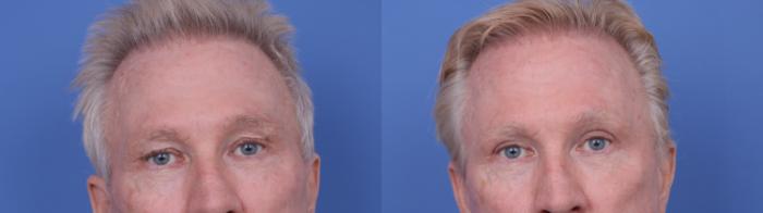 Before & After Blepharoplasty Case 686 Zoom Blepharoplasty View in Scottsdale, AZ